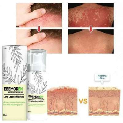 Anti Fungal Spray (Buy 1 Get 1 Free)